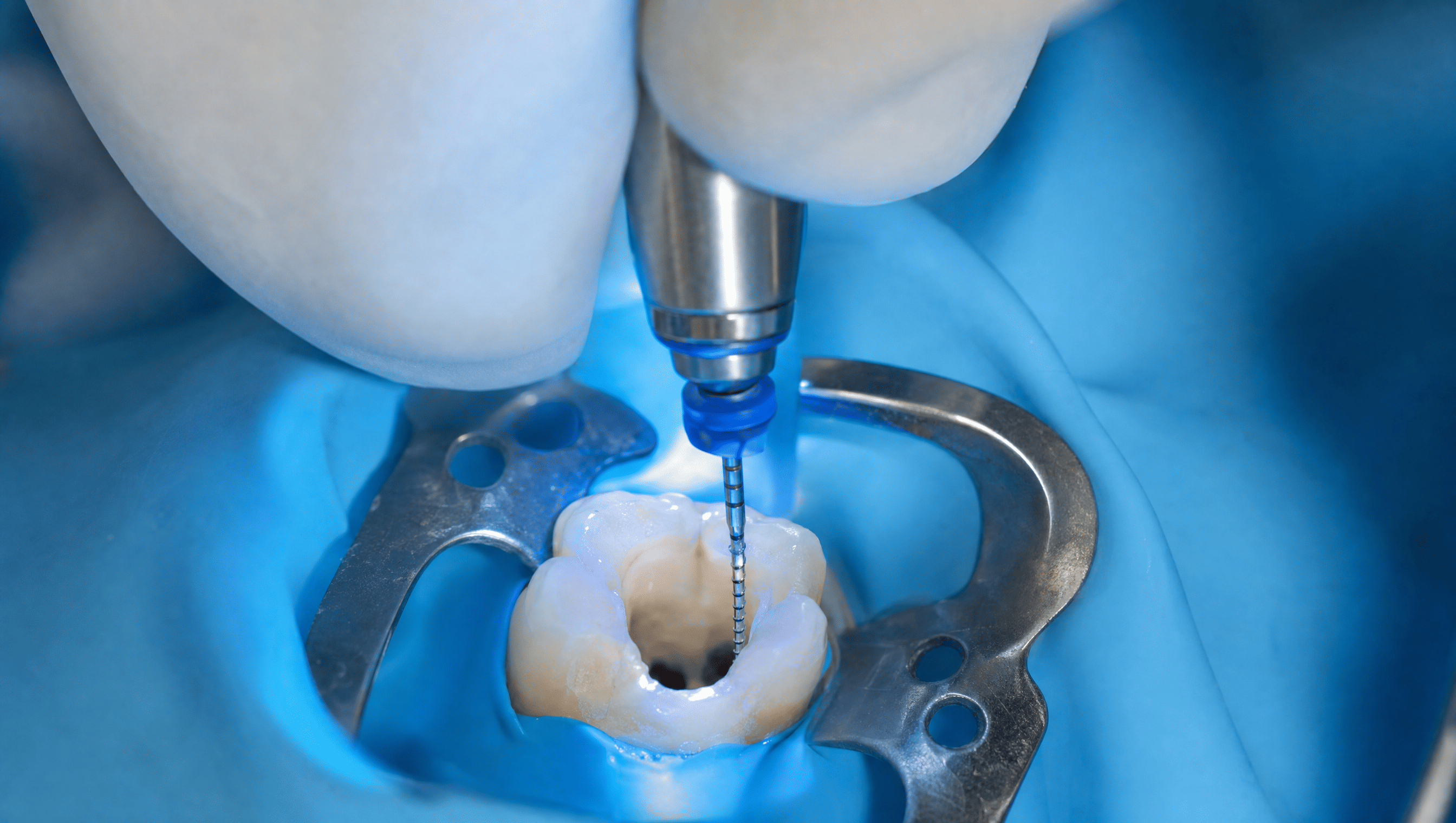 Endodoncia